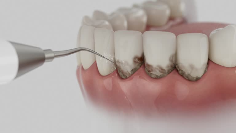 Trusted Dental Implants service in Oxford, OH - Dentist Open Now